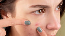 Types of acne lesions and how to fight them?