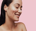 Oily and Acne-Prone Skin